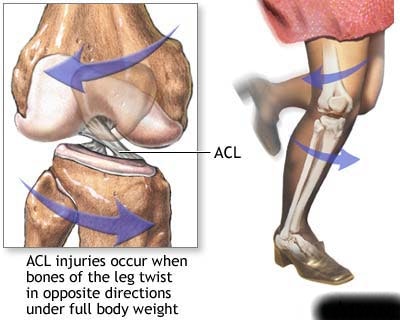 ACL tear cause.bmp